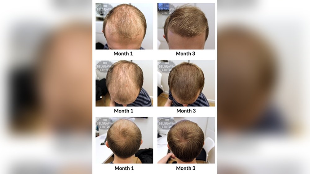 Can Seborrheic Dermatitis Lead to Hair Loss Can Seborrheic Dermatitis Lead to Hair Loss