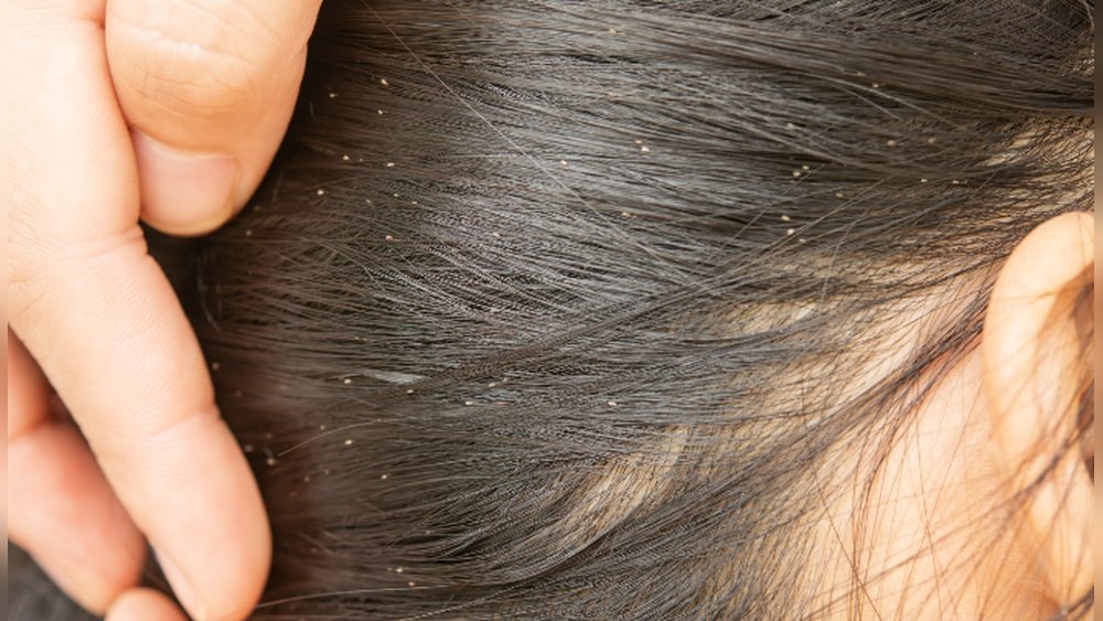 Can Straightening Your Hair Kill Head Lice Can Straightening Your Hair Kill Head Lice