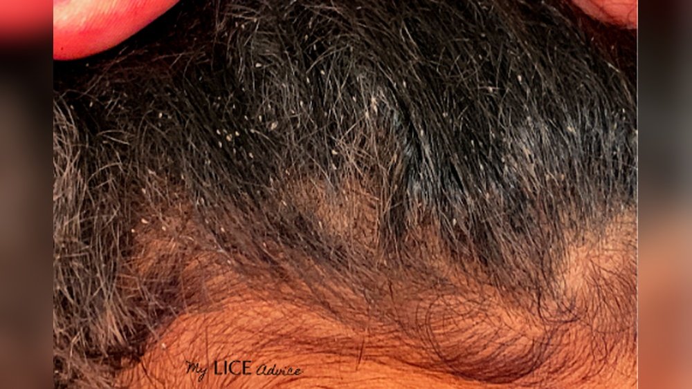 Does Hair Dryer Kill Nits Does Hair Dryer Kill Nits