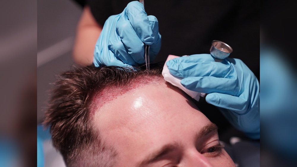 Does Hair Replacement Surgery Work Does Hair Replacement Surgery Work