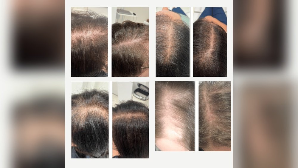 Does Hrt Help With Hair Loss Does Hrt Help With Hair Loss