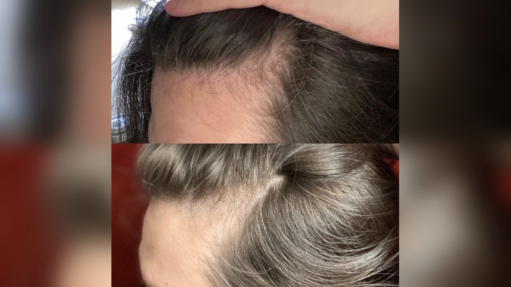 Does Iron Help Hair Growth Does Iron Help Hair Growth