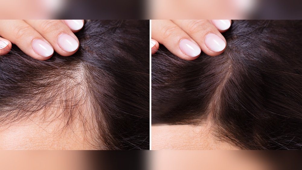 Does Nicotine Cause Hair Loss Does Nicotine Cause Hair Loss