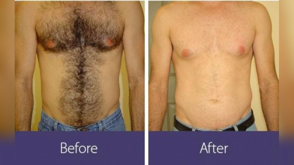 How Much Is Laser Hair How Much Is Laser Hair