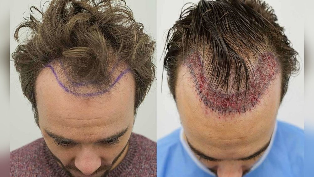 Is Hair Transplant Permanent Is Hair Transplant Permanent
